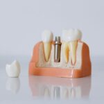 implantes dentales precio
