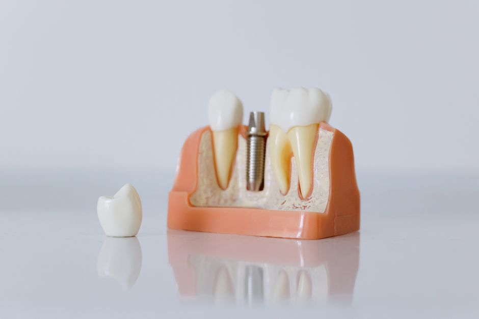 implantes dentales precio